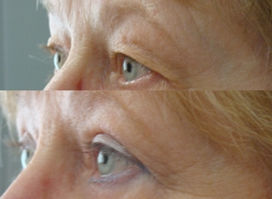 Upper blepharoplasty, after 1 year